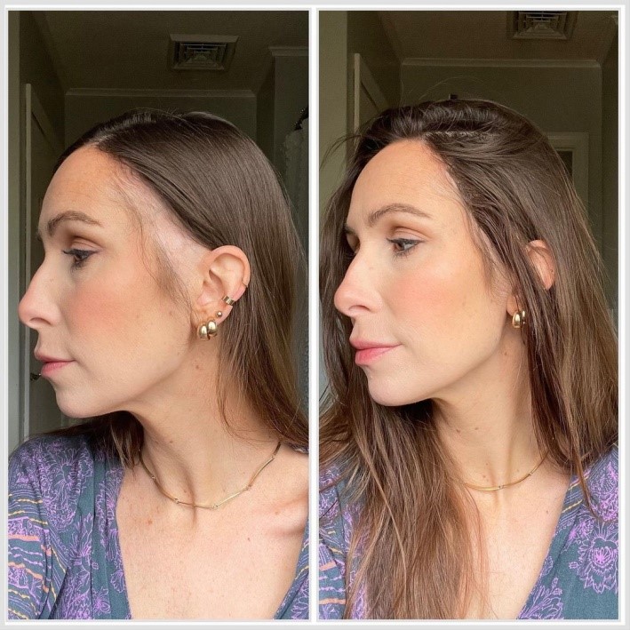 Best Hair Patches For Frontal Fibrosing Alopecia